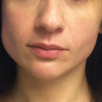 35-44 year old woman treated with Radiesse after 2127716