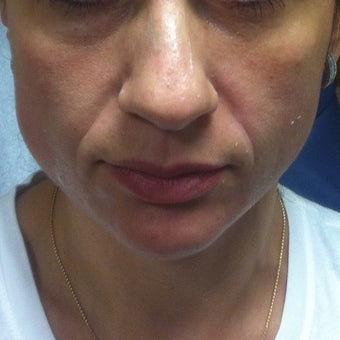 35-44 year old woman treated with Radiesse before 2127716