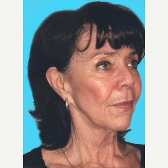 Facelift before 3826917