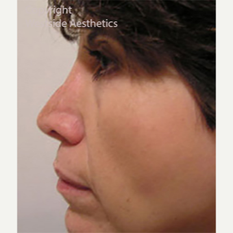 Revision Rhinoplasty before 3005048