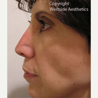 Revision Rhinoplasty after 3005048