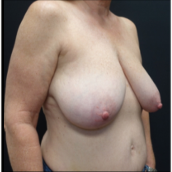 55-64 year old woman treated with Breast Lift before 3130103