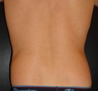 SmartLipo MPX before 1410850