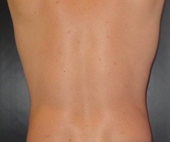 SmartLipo MPX after 1410850