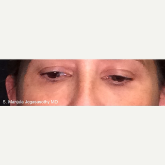 Non-Surgically Shrinking Undereye Fat Pads with Kybella® Injections after 3621624
