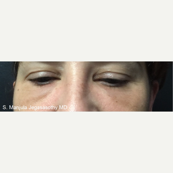 Non-Surgically Shrinking Undereye Fat Pads with Kybella® Injections before 3621624