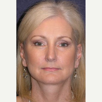 55-64 year old woman treated with Laser Resurfacing after 3466798