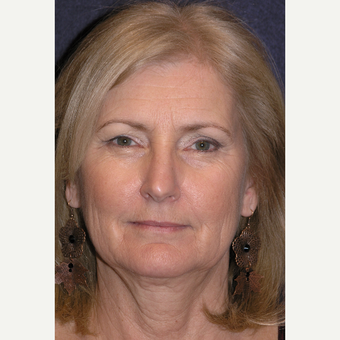 55-64 year old woman treated with Laser Resurfacing before 3466798