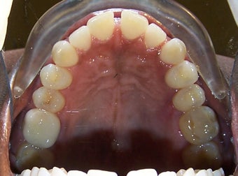 Spaces between the front teeth 930855