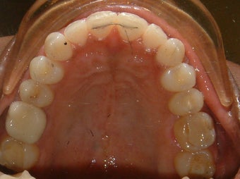 Spaces between the front teeth 930855