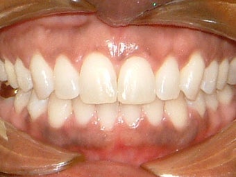 Spaces between the front teeth after 930855