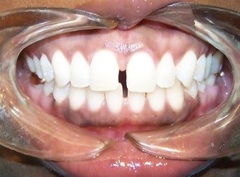 Spaces between the front teeth before 930855
