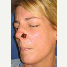 45-54 year old woman treated with Mohs Surgery before 3389182