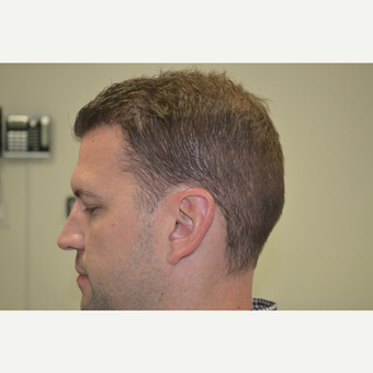 35-44 year old man treated with FUE Hair Transplant after 3077156