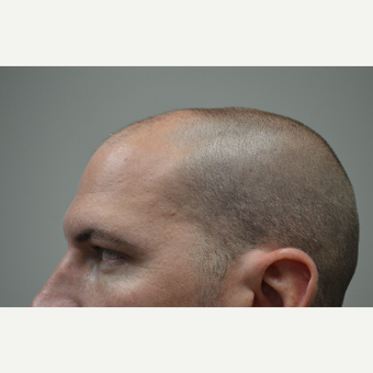 35-44 year old man treated with FUE Hair Transplant before 3077156