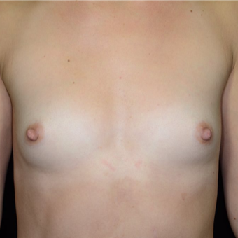 25-34 year old woman treated with Breast Augmentation before 3099236