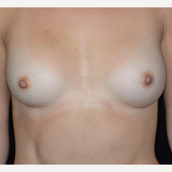 25-34 year old woman treated with Breast Augmentation after 3099236