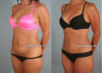 Liposuction of Abdomen and Flanks after 1414130