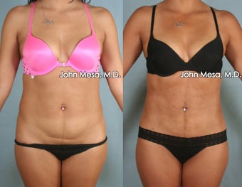 Liposuction of Abdomen and Flanks before 1414130