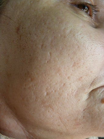 Erbium and CO2 for acne scars before 1520707