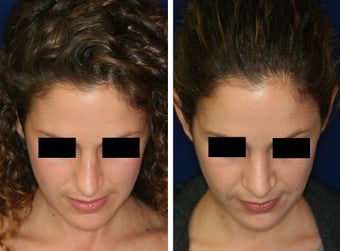 Non Surgical Nose Job before 1429227