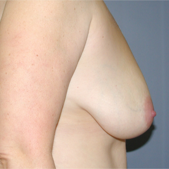 40 year old woman treated with Breast Reduction before 3042837
