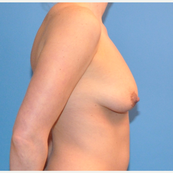 Breast Lift and Augmentation before 3070508