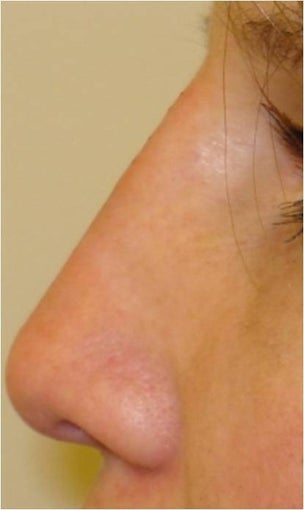 Nonsurgical nose filler with Radiesse after 227719