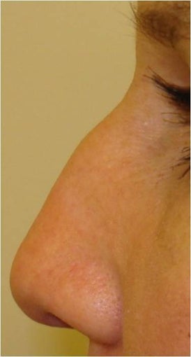 Nonsurgical nose filler with Radiesse before 227719