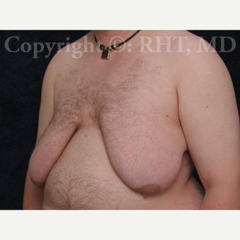 24 yo F-M transgender patient had total mastectomies and NAC grafts for Chest Masculinization 1921417