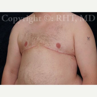 24 yo F-M transgender patient had total mastectomies and NAC grafts for Chest Masculinization 1921417