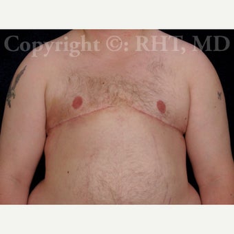 24 yo F-M transgender patient had total mastectomies and NAC grafts for Chest Masculinization after 1921417