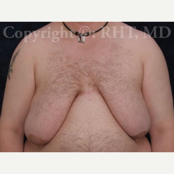24 yo F-M transgender patient had total mastectomies and NAC grafts for Chest Masculinization before 1921417