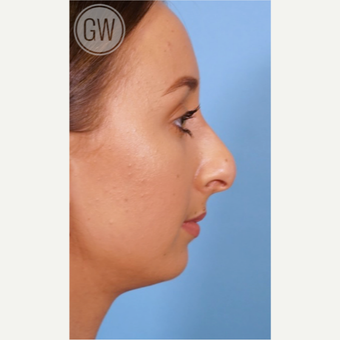 18-24 year old woman treated with Rhinoplasty before 3473410