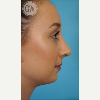 18-24 year old woman treated with Rhinoplasty after 3473410