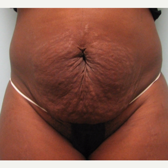 Tummy tuck performed in conjunction with hysterectomy. before 3253548