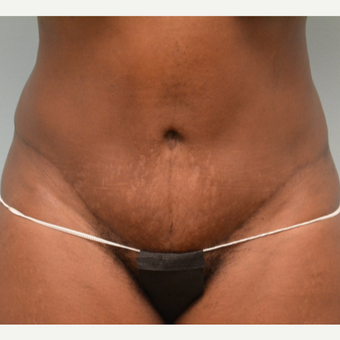 Tummy tuck performed in conjunction with hysterectomy. after 3253548