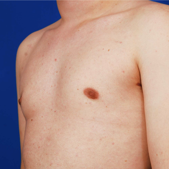 18-24 year old man treated with Gynecomastis Surgery - Male Breast Reduction after 3731563