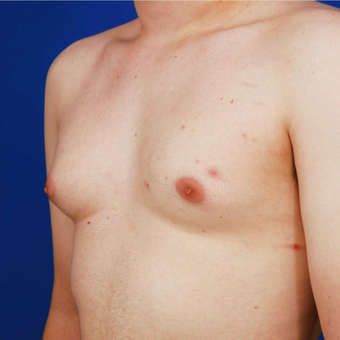 18-24 year old man treated with Gynecomastis Surgery - Male Breast Reduction before 3731563