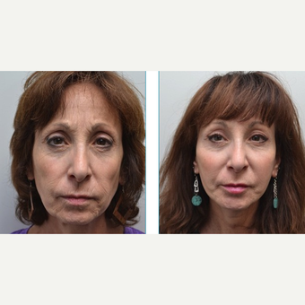 55-64 year old woman treated with Facelift before 3747553