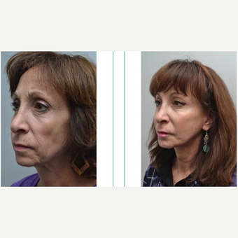 55-64 year old woman treated with Facelift after 3747553