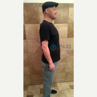 Gastric Bypass success story. ALO Bariatrics after 2480393