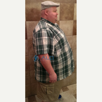 Gastric Bypass success story. ALO Bariatrics before 2480393