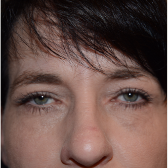 45-54 year old woman treated with Eyelid Surgery after 3294290