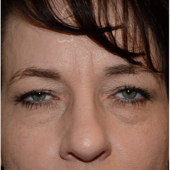 45-54 year old woman treated with Eyelid Surgery before 3294290