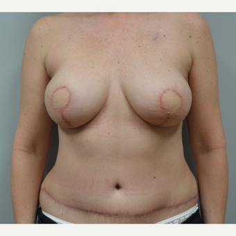55-64 year old woman treated with Breast Reconstruction after 3162105