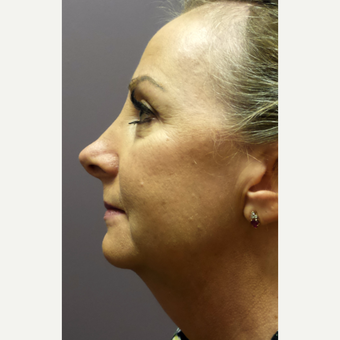 45-54 year old woman treated with Lower Face Lift & Chin Implant before 3059566