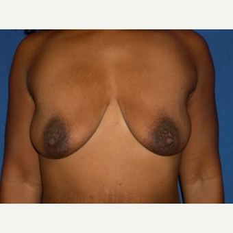 35-44 year old woman treated with Breast Lift with Implants before 3009130