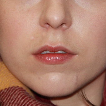 25-34 year old woman treated with Juvederm before 3696249