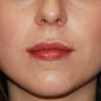 25-34 year old woman treated with Juvederm after 3696249